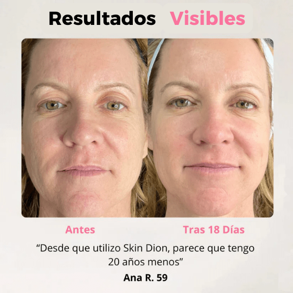 Dispositivo de rejuvenecimiento Facial- Skin dion